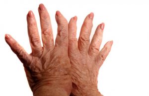 Hands With Arthritis